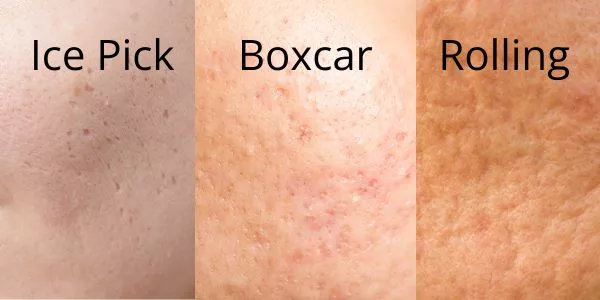 Great candidates for microneedling, with atrophic scars where there was a collagen deficiency during the healing process.