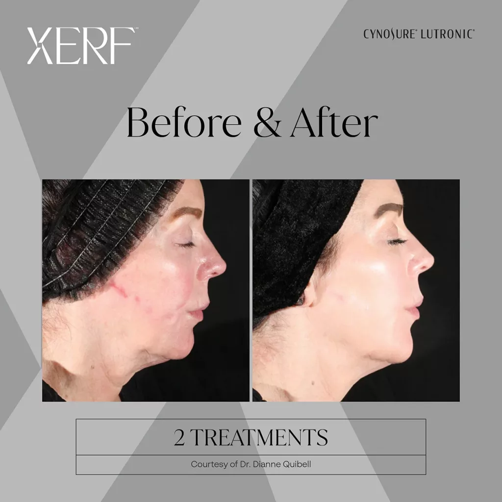 XERF RF skin tightening before and after two treatments with noticeable improvement in facial contour and skin laxity.